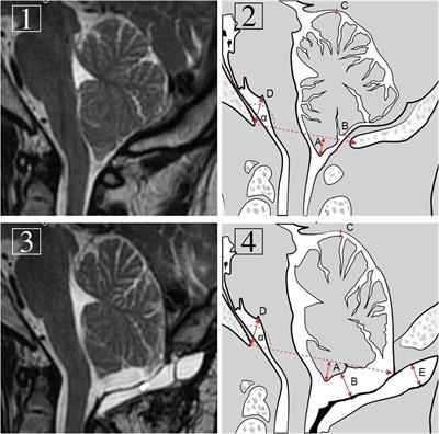 Significance of Pseudomeningocele After <mark class="highlighted">Decompressive Surgery</mark> for Chiari I Malformation